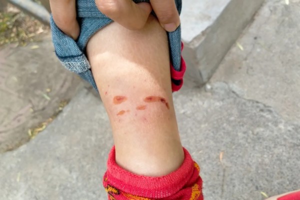 狂犬病能检查出来吗，狂犬病能检查出来