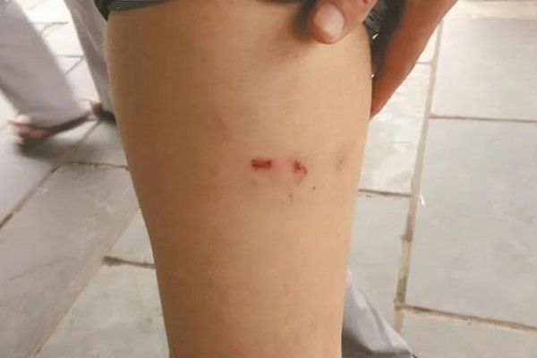 狂犬病能检查出来吗，狂犬病能检查出来