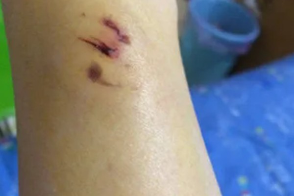 狂犬病能检查出来吗，狂犬病能检查出来