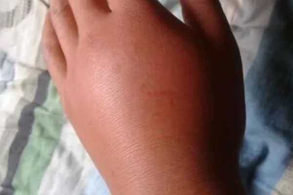 被马蜂蛰了怎么办,夹出毒针再用弱酸性溶液冲洗被蛰处