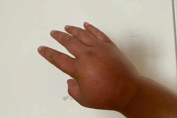 被马蜂蛰了怎么办,夹出毒针再用弱酸性溶液冲洗被蛰处