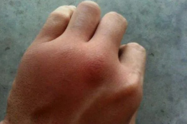 被马蜂蛰了怎么办,夹出毒针再用弱酸性溶液冲洗被蛰处