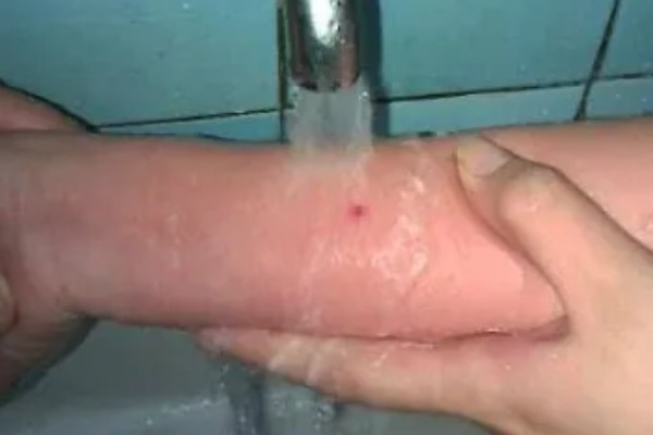 被马蜂蛰了怎么办,夹出毒针再用弱酸性溶液冲洗被蛰处