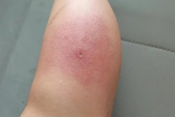 被马蜂蛰了怎么办,夹出毒针再用弱酸性溶液冲洗被蛰处